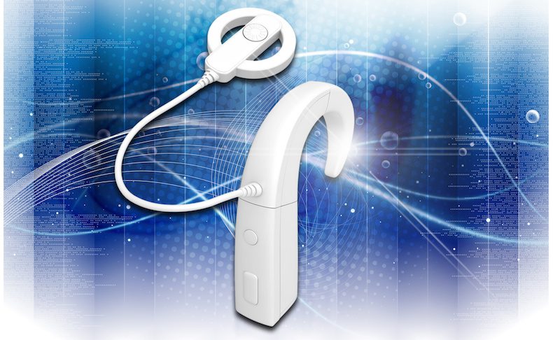 impianto cocleare elettrococleografia