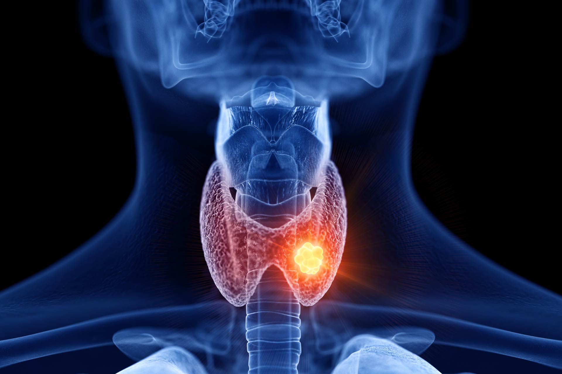 incisione sovraclavicolare laterale